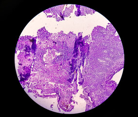 Photomicrograph (microscopic image) Adenocarcinoma. colorectal, pancreas, stomach cancer. 4X