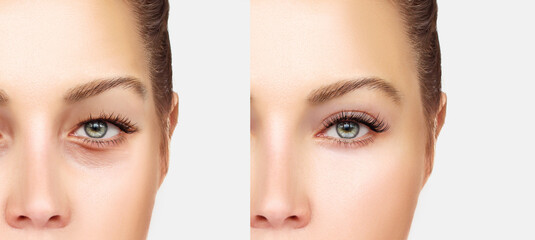 Lower and upper Blepharoplasty.Marking the face.Perforation lines on females face, plastic surgery...