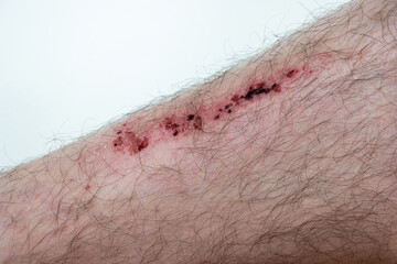 Bruised skin macro close up shot of hairy Caucasian male leg.