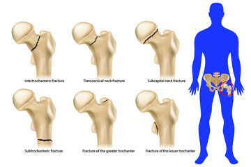 Femoral neck fracture. Types of hip fractures. Subtrochanteric, Intertrochanteric, Transcervical and Subcapital  neck fracture, Fracture of the greater and lesser trochanter. Anatomy - obrazy, fototapety, plakaty