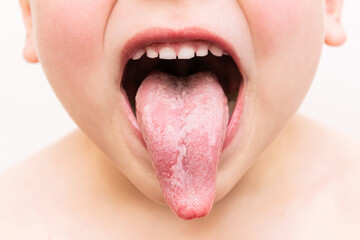 Geographic tongue disease. Cropped shot of a small child shows tongue with inflammatory lesions...
