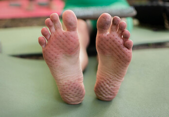 Young womans feet after standing on sadhu board (yoga board)