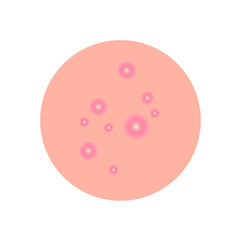 A round piece of skin with pimples. Inflammatory acne on the body. Vector illustration, flat minimal cartoon design isolated on white background, eps 10.