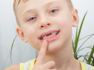 the child points his finger at the hole in his teeth after pulling out baby teeth.
