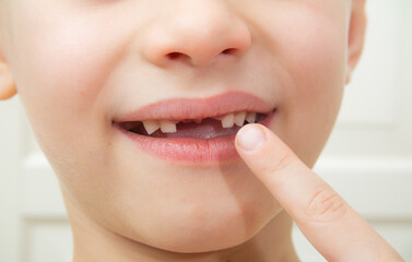 Close-up of the boy on the pulled out baby teeth and is in pain. Tooth loss, a concept of dental problems