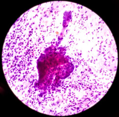Cervical cancer cells. Atypical glandular cells fo undetermined significance(AGUS), Cancer of...