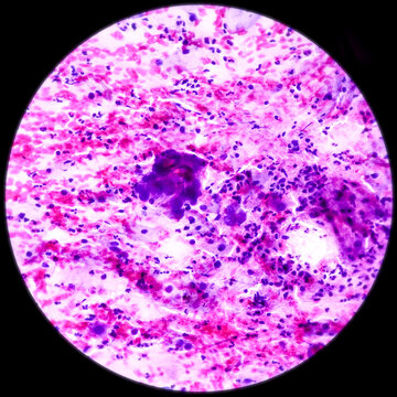 Cervical cancer cells. Atypical glandular cells fo undetermined significance(AGUS), Cancer of cervix, Pap's smear, pap's, microscopic 40x view