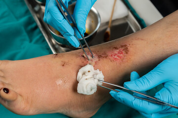 close up doctor cleaning wound on leg, Injuries from falling
