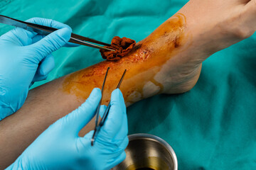 close up doctor cleaning wound on leg, Injuries from falling - obrazy, fototapety, plakaty