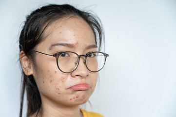 Asian woman having stress cause of acne inflamed on her face. Inflamed acne consists of swelling, redness, and pores that are deeply clogged with bacteria, oil, and dead skin cells.