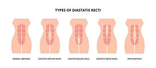 Types of diastasis recti, also known as abdominal separation, common among pregnant women. Abdomen muscles, anatomy, postpartum care 