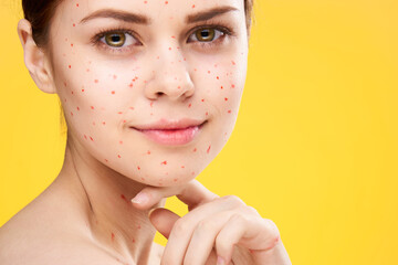 woman with red dots on her face skin problems dermatology dissatisfaction