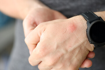 Closeup of red spot on skin of man hand