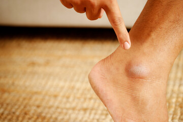 cracked heel treatment The foot cream should be applied regularly. Rub and massage the heels for...