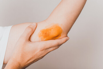 Human left hand elbow injury, close up. Unrecognizable person showing site of injury smeared with...
