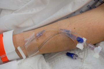 IV intravenous tubes and needle in a Covid infected patient in a hosptial bed