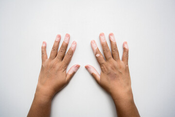 Hands with Vitiligo skin condition against white background with copy space