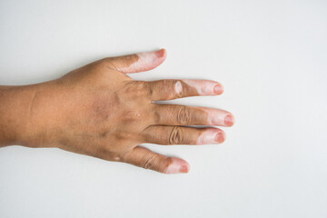 Woman's hand showing vitiligo against white background