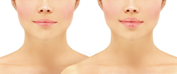 Beauty injections.Concept of rejuvenation.Lip augmentation