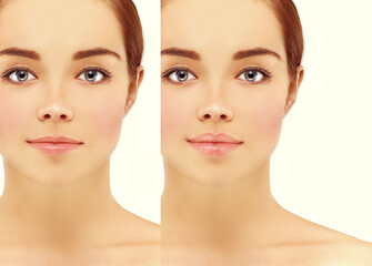 Beauty injections.Concept of rejuvenation.Lip augmentation