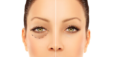 Fototapeta premium Lower eyelid blepharoplasty.Upper blepharoplasty.Before and after cosmetic procedures