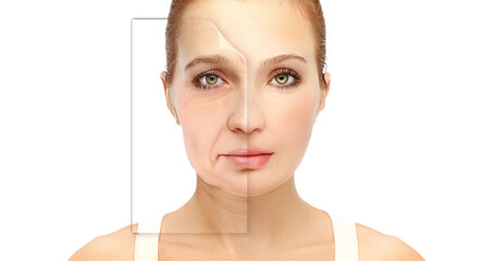 Plastic Surgery Results,Nasolabial folds,Neck ,Under eye circles,neck lines.