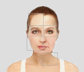 Plastic Surgery Results,Nasolabial folds,Neck ,Under eye circles,neck lines.