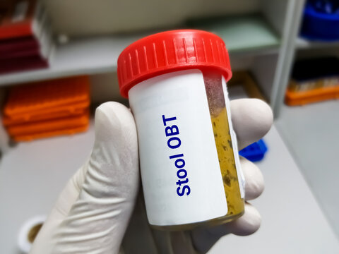 Doctor holding stool sample container for occult blood test (OBT).OBT is a lab test used to check stool samples for hidden (occult) blood at laboratory.