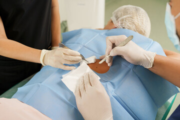 Doctor and nurse during birthmark removal dermatologic surgery