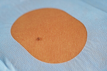 Birthmark removal - dermatologic surgery