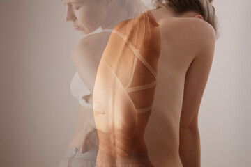 Woman suffering from back pain. Scoliosis Spine Curve Anatomy, Double exposure - obrazy, fototapety, plakaty