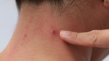 Fototapeta premium painful inflamed damage acne on neck 