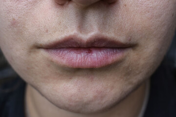 Fototapeta premium Quarantined home care. lip crack. unkempt face. female antennae