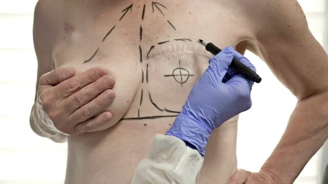 Preparing for breast reconstruction for a woman undergoing mastectomy. Breast plastic surgery after mastectomy.