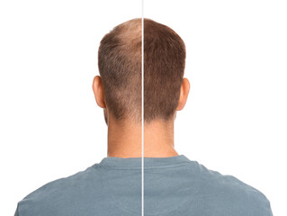 Man with hair loss problem before and after treatment on white background, collage. Visiting...