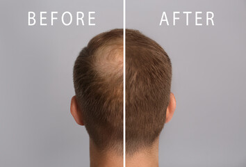 Man with hair loss problem before and after treatment on grey background, collage. Visiting...