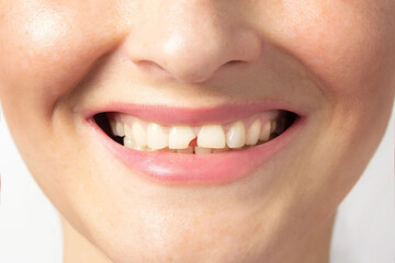 Woman shows broken tooth. Need a Dentist. Close up photo white background.