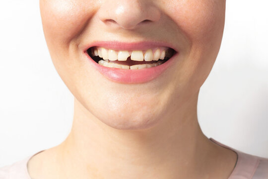 Woman shows broken tooth. Need a Dentist. Close up photo white background.