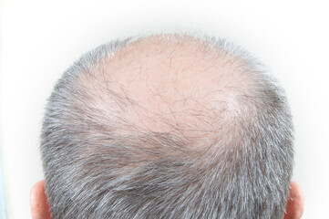 bald spot on the head, gray hair, close-up view from behind, the problem of hair loss.