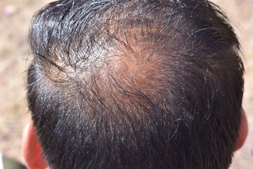 Male baldness, hair loss, early baldness closeup, The concept of scalp health