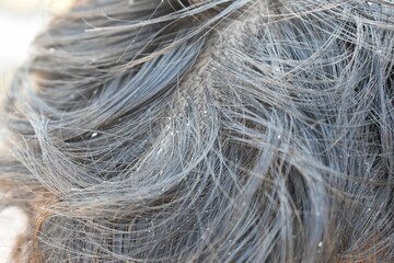 Dandruff on the head of Asian man closeup, The concept of scalp health