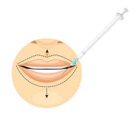 Lip line correction by injections. Cosmetic surgery on female face with dotted lines vector illustration