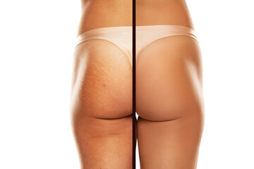 comparison before and after Woman buttocks with stretch marks removal treatment