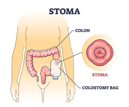 Stoma bag after colon surgery as medical patient drainage outline diagram. Labeled educational digestive problem solution scheme with anatomical gastrointestinal tract procedure vector illustration