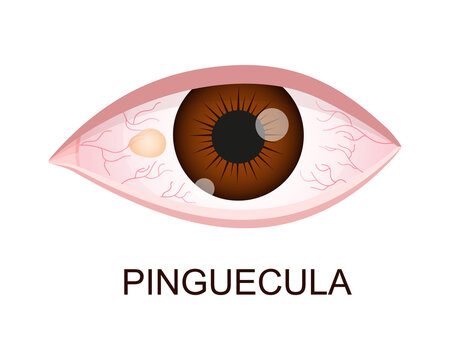 Pinguecula. Conjunctival degeneration. Eye disease. Human organ of vision with pathology. Vector realistic illustration.