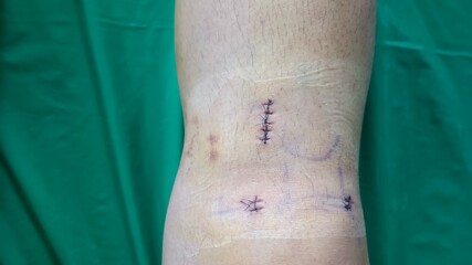 laparoscopic surgery, wound of patient after treatment with Minimally Invasive Surgery, anterior cruciate ligament treatment