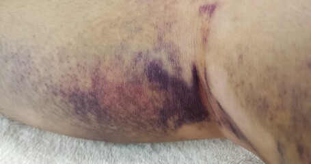bruised skin on leg of patient, patient skin after knee surgery process, rehabilitation and...