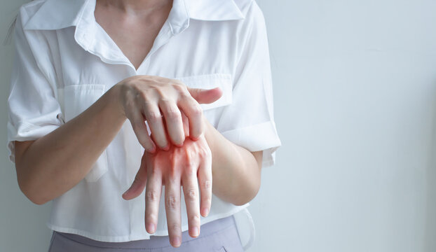 woman is scratching hand  with itching of skin diseases in inflaming. A Concept of Healthcare And Medicine.