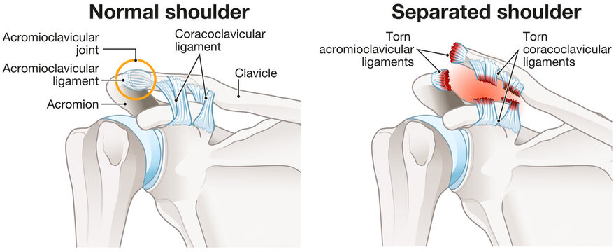 Acromioclavicular joint separation or AC joint separation or shoulder separation. Illustration