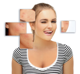 Post-Acne Marks ,Treating Acne Scars.Acne Scar Removal